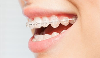 Clear ceramic braces